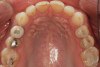 (4.) Preoperative occlusal view of upper arch.