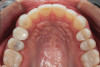 (13.) Postoperative occlusal view of upper arch.