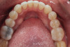 (14.) Postoperative occlusal view of lower arch.