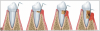 Fig 2. Plaque and calculus deposits result in local inflammation and hard and
soft tissue destruction in periodontal disease.