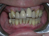 Fig 6. Following rubber cup polishing and complete stain removal.Fig 6. Following rubber cup polishing and complete stain removal.