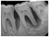 (6.) Initial periapical radiograph taken on November 15, 2015, showing infrabony defect approaching the apex of the distal root of tooth No. 19, on which there was a calcified mass (hypercementosis) and evidence of furcal bone loss. The entire distal root of tooth No. 18 appeared to have no bone support, and a small arrested carious lesion was noted on the distal crown of tooth No. 18. Teeth Nos. 17 and 18 were initially given a hopeless prognosis and slated for extraction.