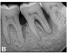 (8.) Progressive improvement in bone quality, quantity, and morphology during each time period, especially in the furcation area of tooth No. 18, which shows a noticeable narrowing of the width of the bony defects, slight apical resorption of the distal root of tooth No. 18, and the encasing of residual cementum on the distal root of No. 19 by new bone formation. Periapical radiographs were taken of teeth Nos. 17, 18, and 19 on June 25, 2016, January 28, 2017, August 23, 2019, and September 4, 2020, respectively, the final of which was taken after almost 5 years post-initial scaling and root planing and alternating supportive periodontal maintenance.