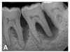 (11.) Preoperative periapical radiograph taken on November 11, 2015.