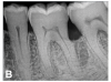 (12.) Follow-up radiographs taken of teeth Nos. 17, 18, and 19 on September 4, 2020 after almost 5 years post-initial scaling and root planing and alternating supportive periodontal maintenance therapy only.