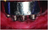 Fig 2. A patient presented with inflammation around implants. The patient was having difficulty brushing the area due to a shallow vestibule, the proximity of the implants, and a lack of keratinized tissue surrounding the implants.