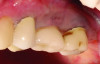 Fig 5 and Fig 6. Pre- (Fig 5) and post-treatment (Fig 6) photographs of a patient who received resective implant surgery to assess peri-implantitis at sites Nos. 14 and 15. Note the improved cleansability of the implants after surgery that opened the embrasure (Fig 6). The patient was placed on 3-month supportive peri-implant care post-surgery.