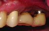 Fig 5 and Fig 6. Pre- (Fig 5) and post-treatment (Fig 6) photographs of a patient who received resective implant surgery to assess peri-implantitis at sites Nos. 14 and 15. Note the improved cleansability of the implants after surgery that opened the embrasure (Fig 6). The patient was placed on 3-month supportive peri-implant care post-surgery.