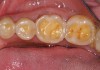 Figure 2  This patient with a history of chronic alcoholism and frequent night vomiting has dissolved the occlsual surfaces of his posterior teeth.