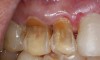 Figure 3  In a patient who smoked a pipe, the nicotinic acid causing tooth erosion was accentuated by the use of a highly abrasive smoker’s toothpaste. Some of the teeth have been restored with bonded composite resin.
