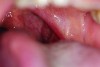 Fig 9. Case 2 clinical photograph showing the large size of the patient’s tonsils.