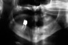 Figure 4  Radiograph of oral bisphosphonate user.