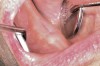 Figure 5  After 2 months of healing, the lower right quadrant showed no signs of BRONJ and the anterior teeth were scheduled for extraction.