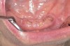 Figure 6  After 2 months of healing, the lower right quadrant showed no signs of BRONJ and the anterior teeth were scheduled for extraction.