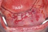 Figure 8  Sutures were placed after extraction.