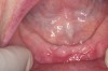 Figure 9  For this quadrant, no signs of BRONJ were observed after 2 months of healing.