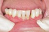 Figure 10  Patient who takes oral bisphosphonates and suffers from periodontal diseas.
