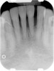 Figure 11  The radiograph shows 80% bone loss.