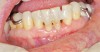 Figure 12  Facial view of composite splint.