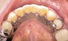 Figure 13  Occlusal view of composite splint.