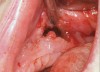 Figure 15  Removal of the necrotic bone material.