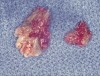Figure 16  Necrotic bone.
