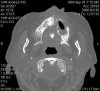 Figure 17  CT scan showing extensive bone loss.