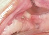 Figure 19  Infection seen after the biopsy.