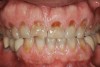 Figure 1  Classic presentation of the bruxism triad. Lateral wear pattern, generalized buccal tooth loss from erosion and abrasion, and history of sleep disruption.