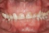 Figure 2  Asymmetric tooth wear in a bruxism triad patient as a result of friction from bruxing, poor salivary lubrication as a byproduct of medication, and roughened surfaces created as a result of erosive reflux.