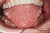 Figure 4  Indentations on tongue caused by forceful pressing of tongue on lingual surfaces. By pushing the tongue anteriorly, the airway is opened.