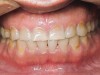 Figure 8  Young adult with signs and symptoms of the bruxism triad: Lateral tooth wear, erosive and abrasive damage to the teeth, and a history of moderate apnea.