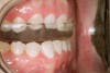 Figure 17  Patient positioned at 40% of voluntary protrusion.