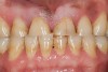 Figure 21  Mature patient with the bruxism triad. Lifetime history of bruxism, snoring, intermittent poor sleep, and GERD symptoms. Sleep study results indicate severe apnea.